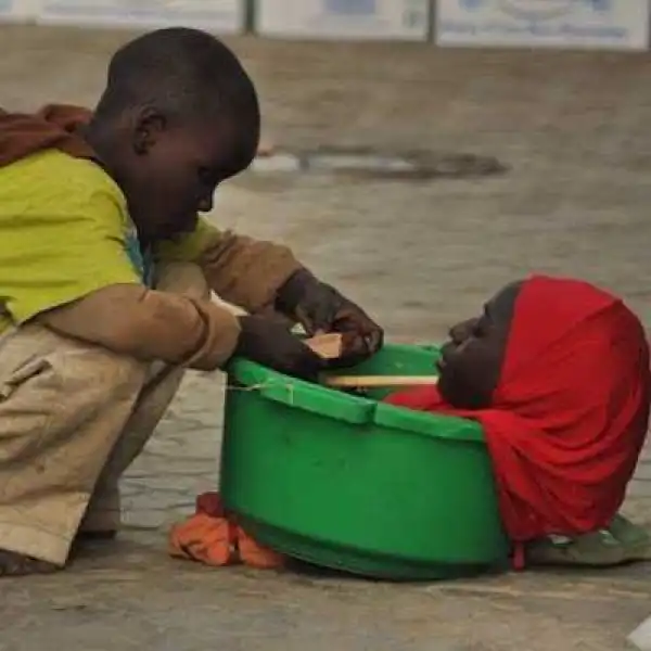 19-Year-Old Girl Who Lives In A Plastic Bowl Dies